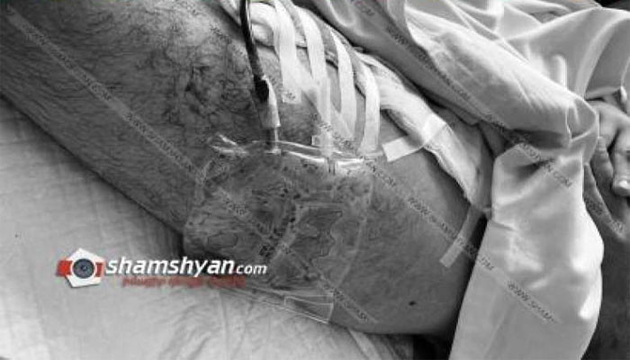 Երևանում դպրոցի տնօրենի 18-ամյա որդին դանակահարել է ՍՊԸ-ներից մեկի փոխտնօրենին