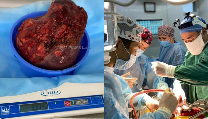 В Алма-Ате врачи удалили из печени женщины гигантского паразита