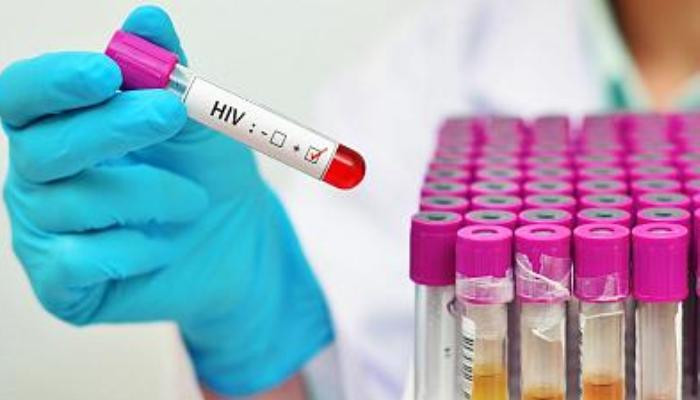 Highly Virulent HIV Variant Discovered in the Netherlands