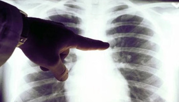 Թոքի քաղցկեղ ունեցողների ավելի քան 95%-ը ծխել է․ ԱՆ