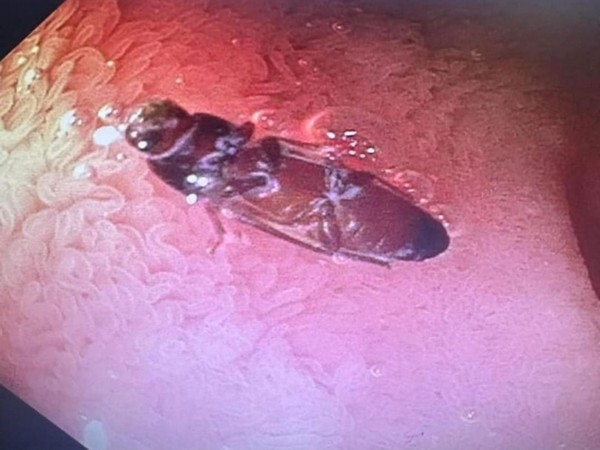 Doctors remove live cockroach from intestine after Delhi man complains of stomach ache